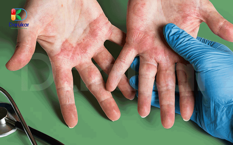 اگزمای دست (Hand Eczema)