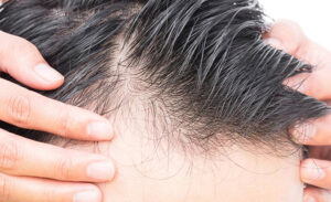 پک تخصصی ضد ریزش مو، سری 2